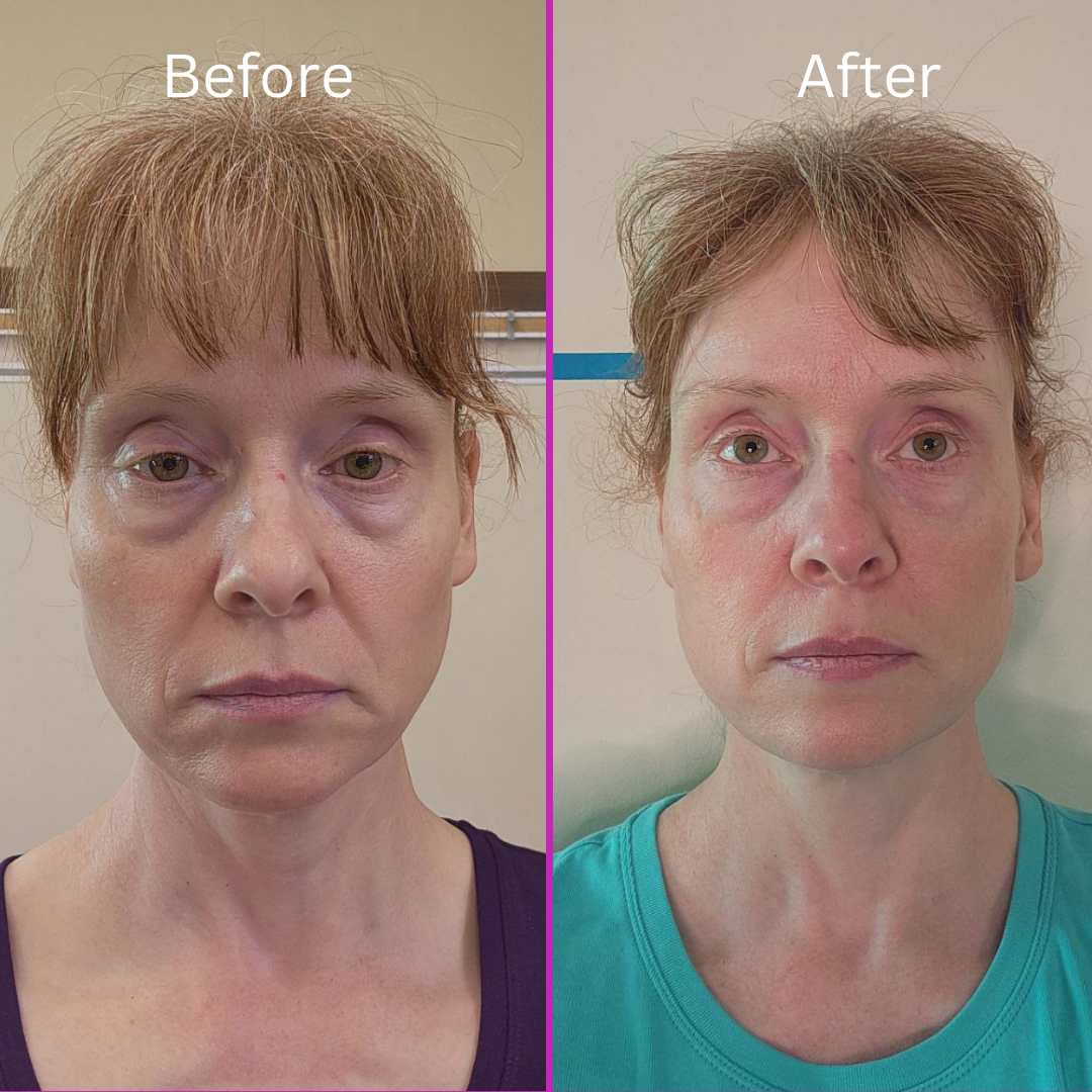 ybtTransformations 1 Stasi Younger By Tonight Before & After Photo